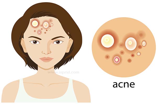 Acne: Everything you should know - i-Sprid