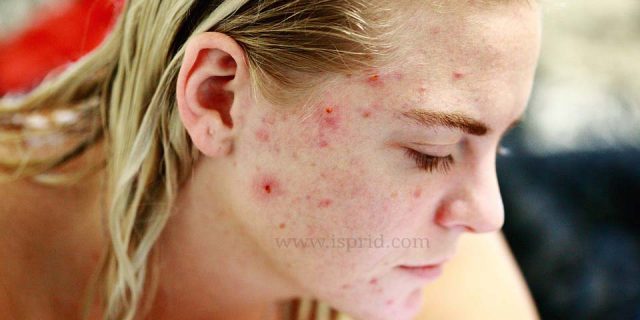 Everything you should know Acne